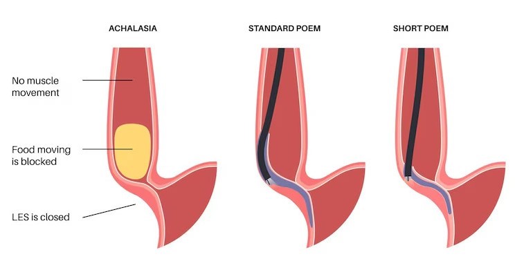 Peroral Endoscopic Myotomy (POEM)