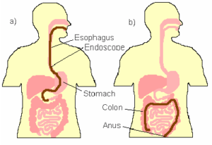 UGI Endoscopy vs. Colonoscopy